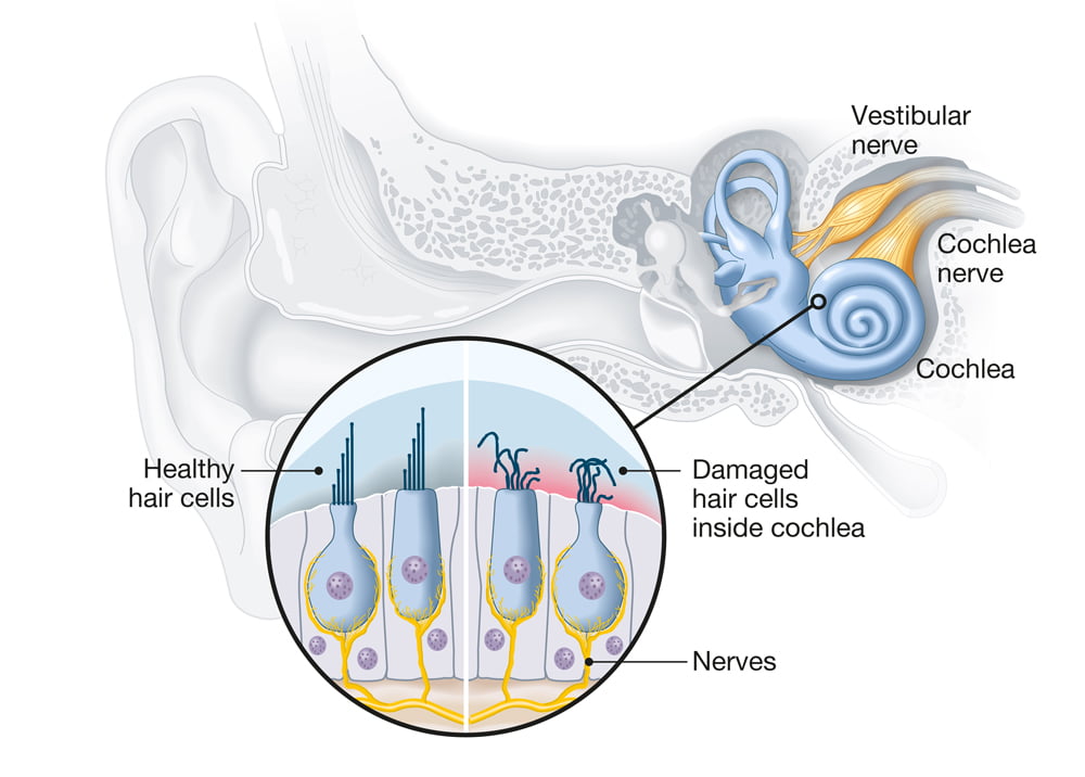 Healthy and damaged hair cells inside cochlea