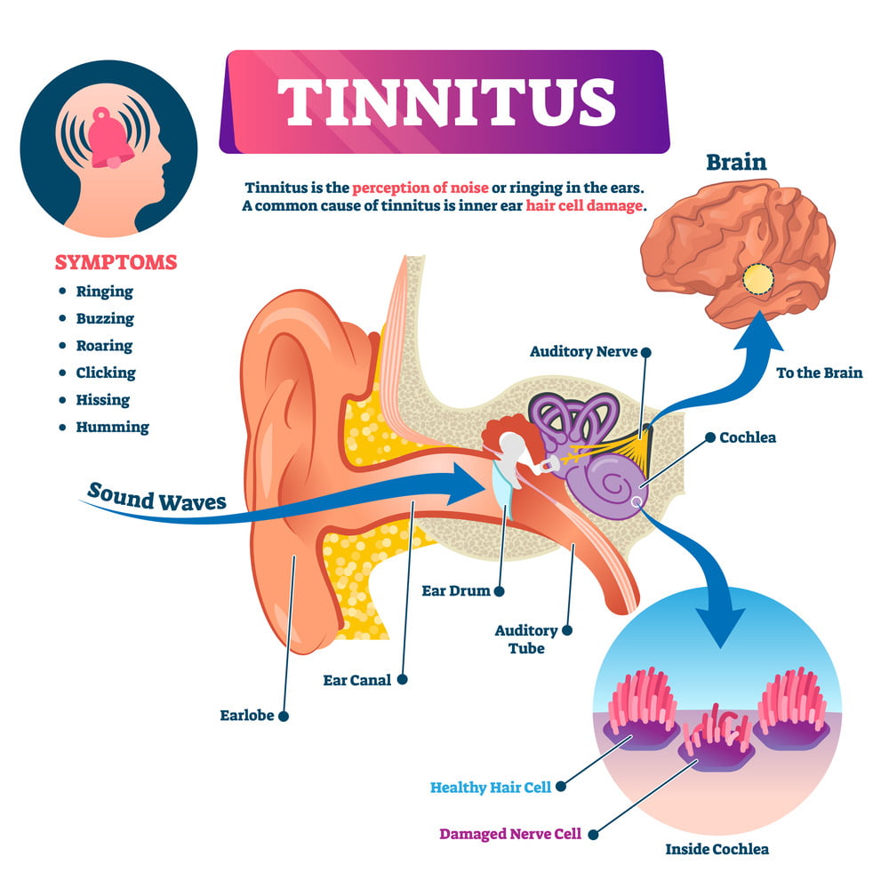 Informational tinnitus graphic